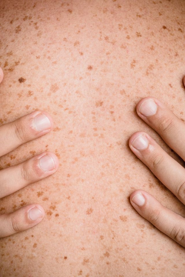 rash skin